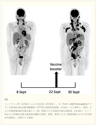 新型コロナワクチンの接種によって癌が急速に進行する可能性
